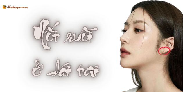 nốt ruồi xuất ngoại